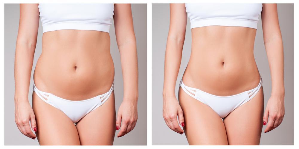 Can Coolsculpting Cause Loose Skin